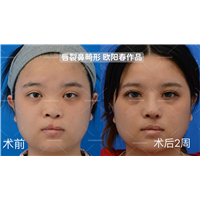 欧阳春教授唇裂鼻修复