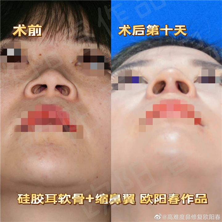 欧阳教授美容性初鼻案例