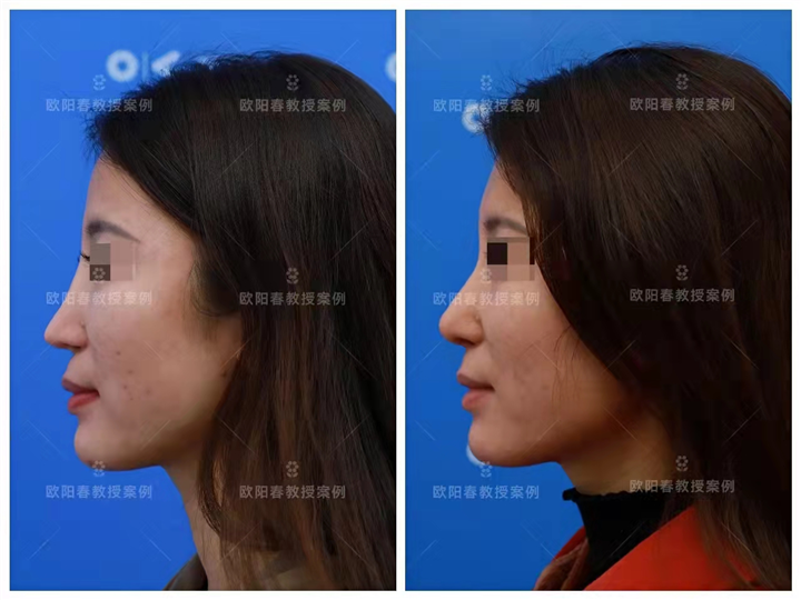 欧阳春整形医生