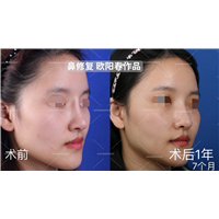欧阳教授高难度鼻修复