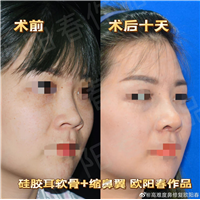 欧阳教授美容性初鼻案例