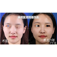 欧阳教授高难度鼻修复