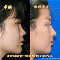 欧阳教授美容性初鼻案例