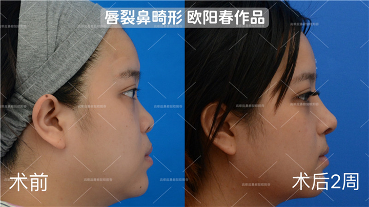 欧阳春教授唇裂鼻修复