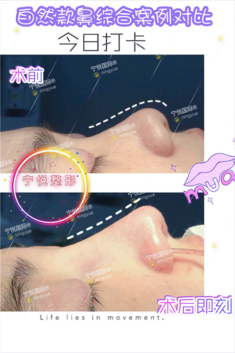 重度挛缩鼻修复