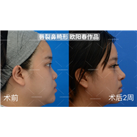 欧阳春教授唇裂鼻修复