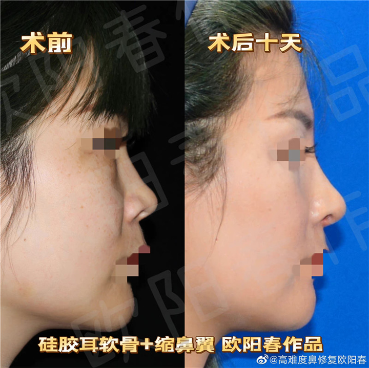 欧阳教授美容性初鼻案例