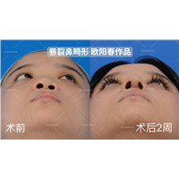 欧阳春教授唇裂鼻修复
