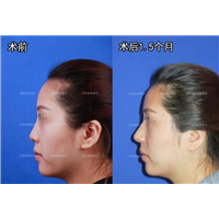 高难度鼻修复欧阳春