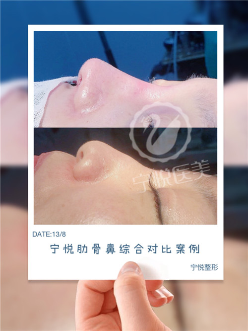 广州假体隆鼻/广州鼻子假体填充