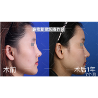 欧阳教授高难度鼻修复