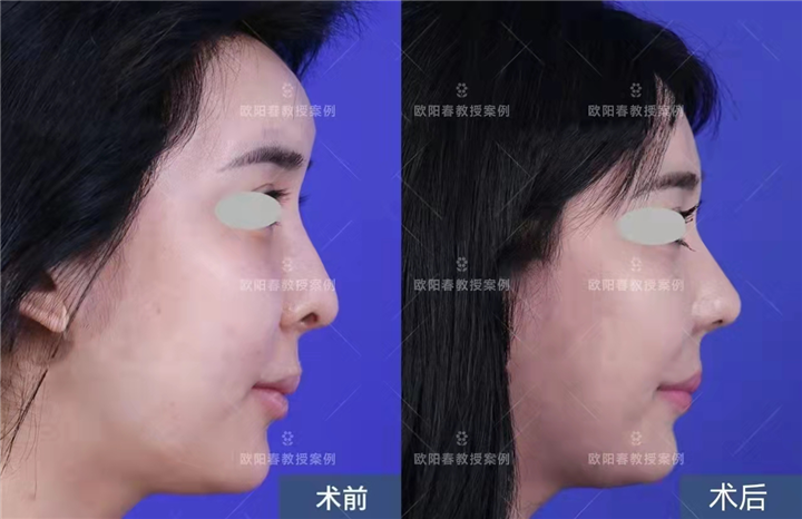 欧阳春隆鼻怎么样