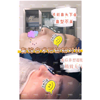 欧阳春鼻修复