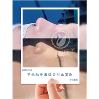 广州假体隆鼻/广州鼻子假体填充