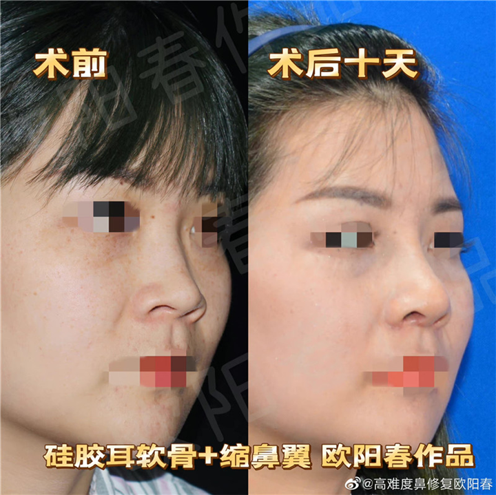 欧阳教授美容性初鼻案例