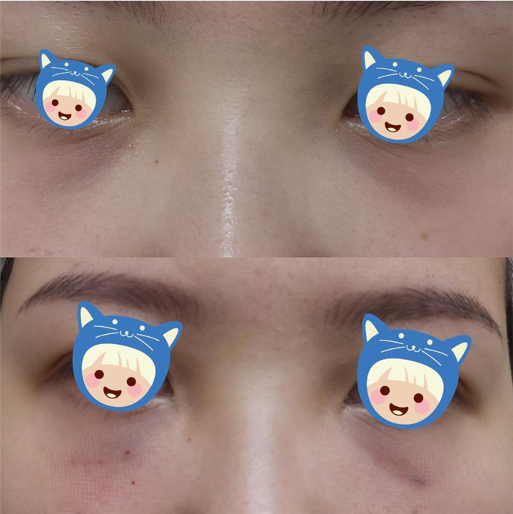 皮肤科医生徐辉教你3招告别鱼尾纹