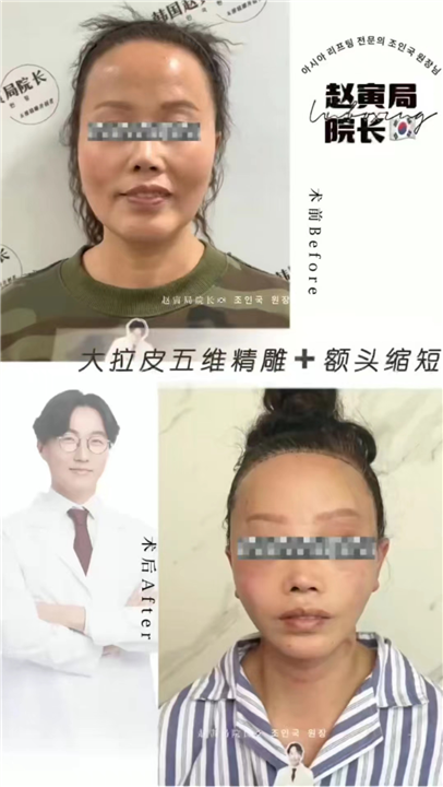 赵寅局大拉皮五维精雕➕额头缩短