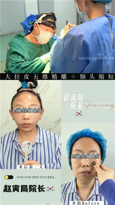 上海赵寅局拉皮下颌线清晰可见