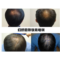 盘锦毛发移植培训