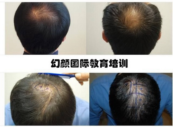 盘锦毛发移植培训