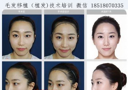 盘锦微整形培训机构|盘锦正规微整形培训班