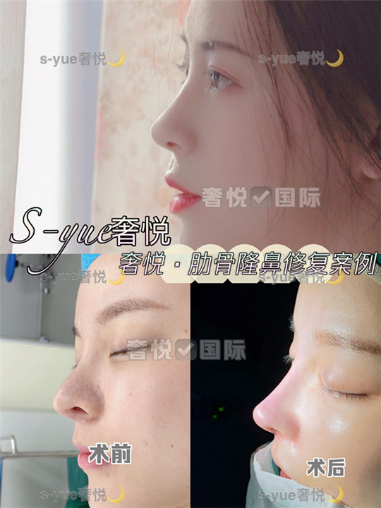 奢悦国际鼻部整形误区科普 