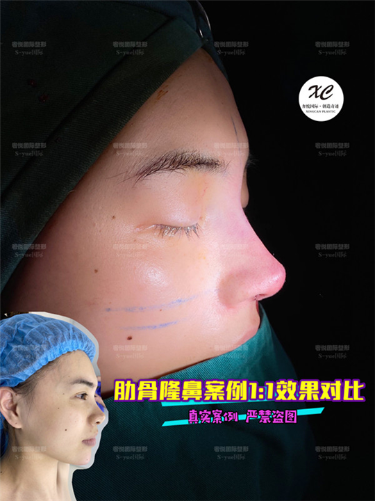 上海星璨奢悦鼻整形修复 