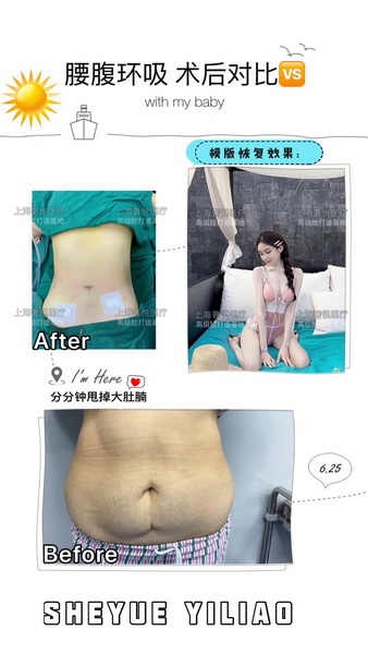 上海肋软骨隆鼻修复