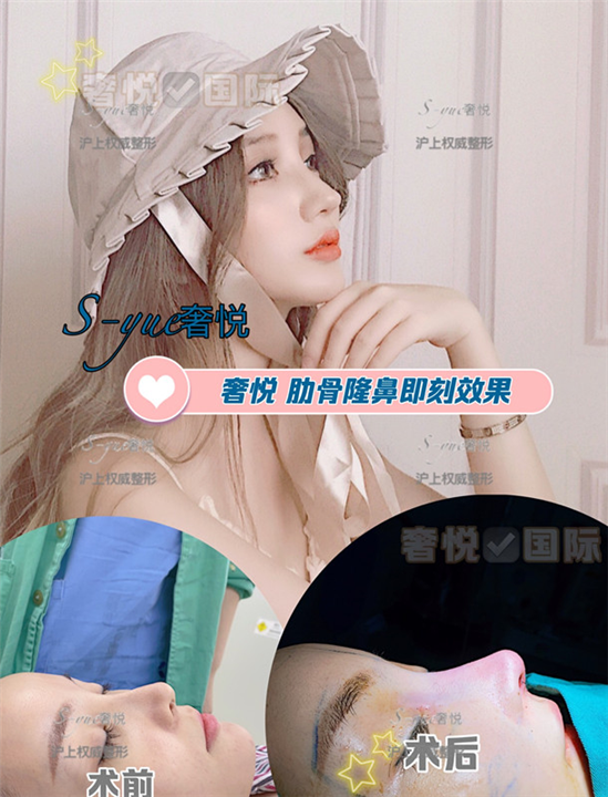 上海做肋骨鼻整形哪家好 