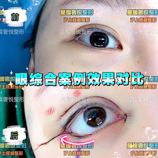 上海网红脸修复