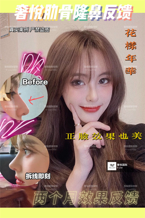 奢悦医疗鼻综合整形可以改变鼻型 