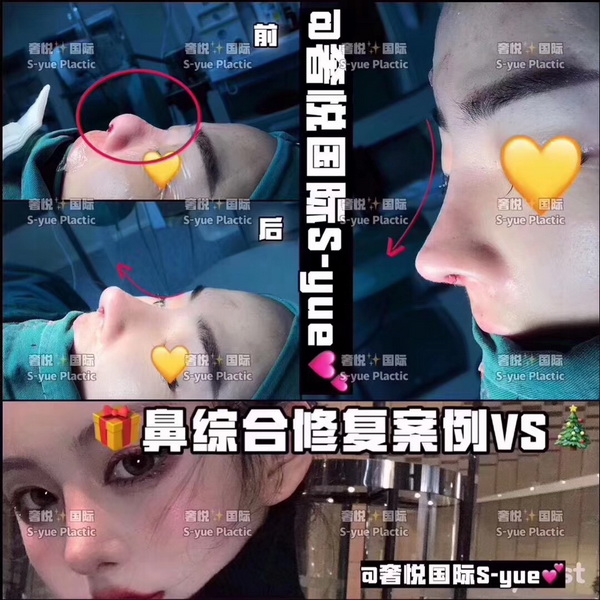 上海星璨奢悦整形——鼻部整形误区科普 