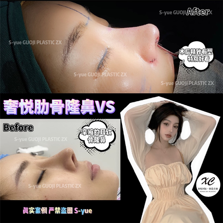 上海肋骨鼻整形哪家比较好 
