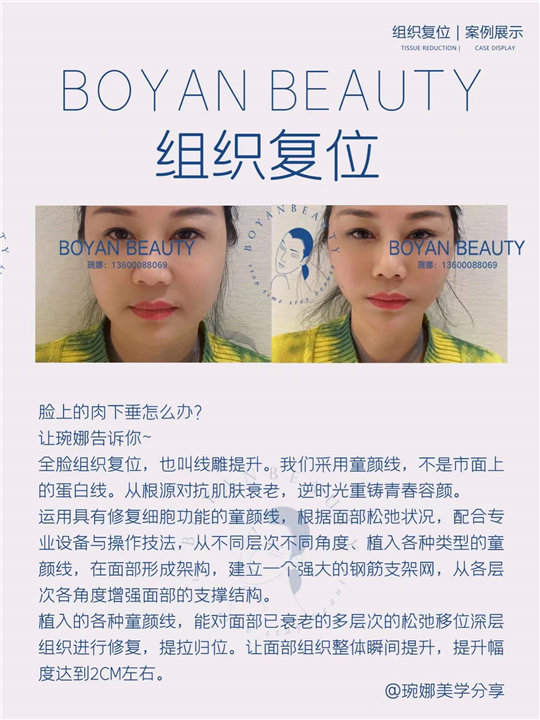 Tissue reduction