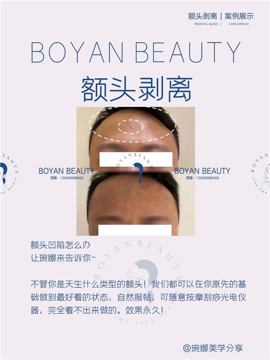 Frontal exfoliation