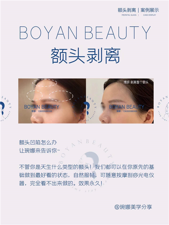 Frontal exfoliation