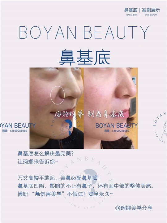 Nasal basal detachment