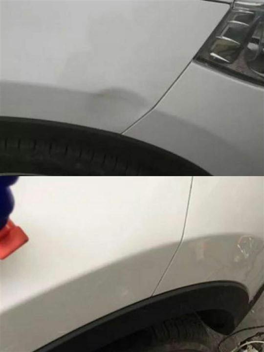 凹陷修复