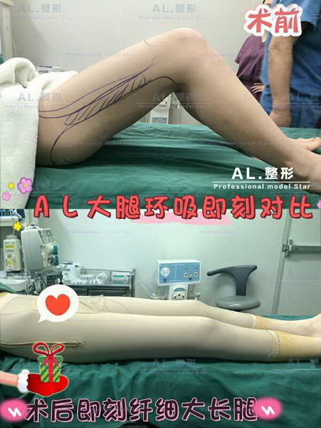 AL整形