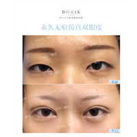 蝶羽双眼皮割窄一点就自然吗