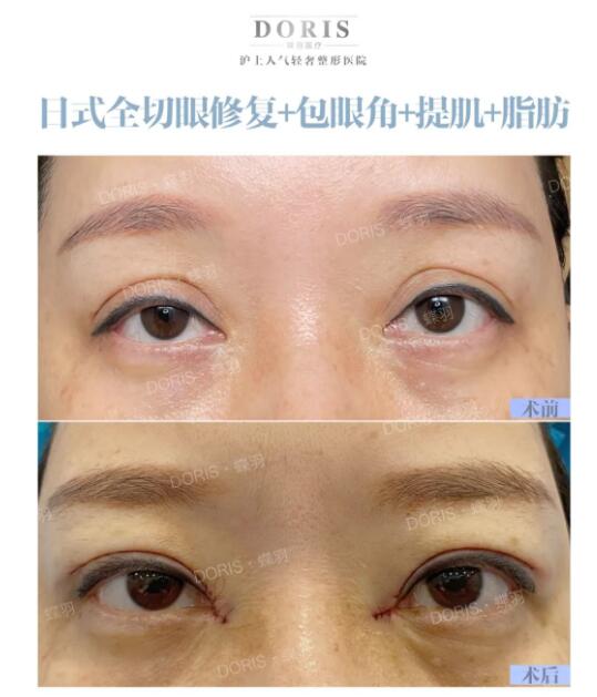 外折改内折打造自然款双眼皮