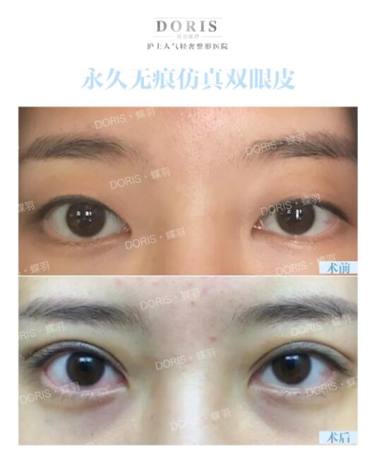 蝶羽马生款的自然双眼皮是怎么做的