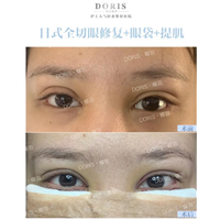 蝶羽医疗讲述大小眼