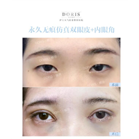 单眼皮要不要变双先要搞清楚这些问题