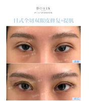 双眼皮手术后为什么会出现睁眼费力的情况