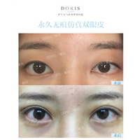 蝶羽马生款的自然双眼皮是怎么做的