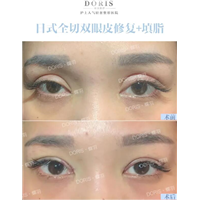 凹陷型的双眼皮想要宽窄一定要填坑吗