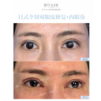 二十几岁为什么你的眼睛提前就抗老了