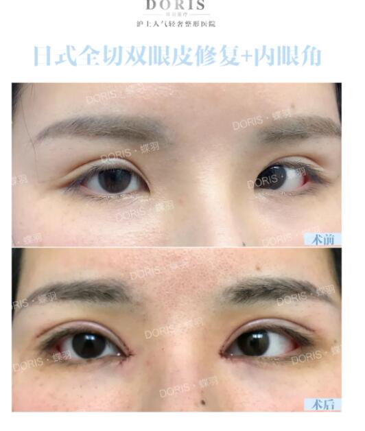 上海李勇医生双眼皮是不是做的越大越好看