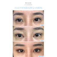 为什么做双眼皮的人十有八九要开眼角